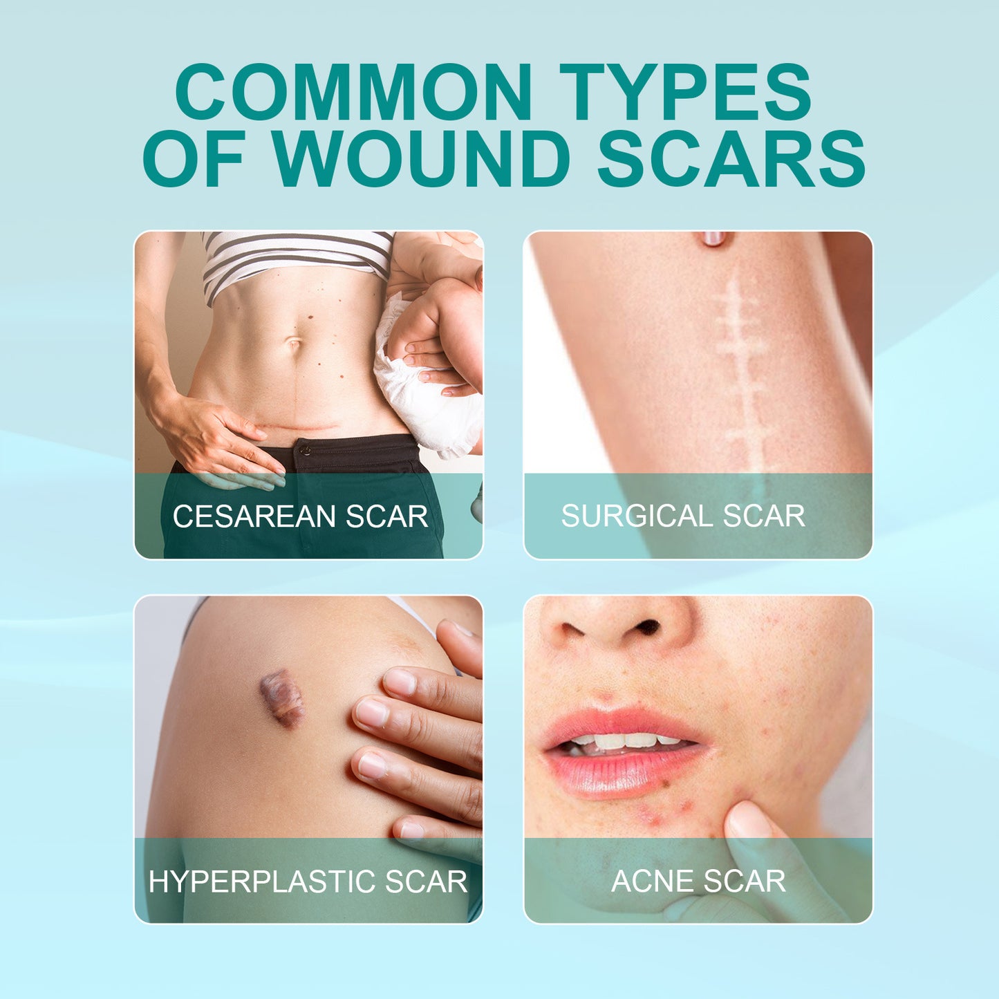 Surgical Scar Spray - Medical Grade