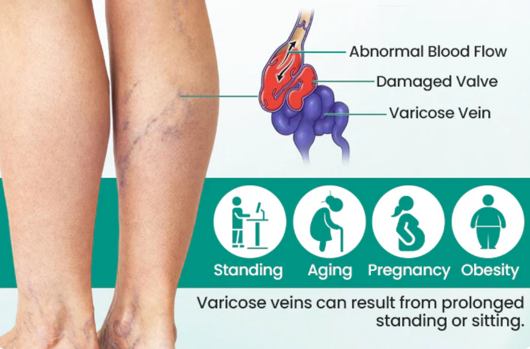 Varicose Vein Relief Patch